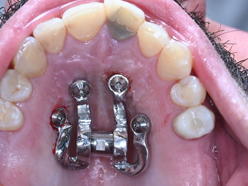 De expander direct na plaatsing op de schroeven.