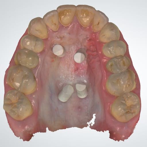 Intraorale scan met scanbodies op de vier schroeven: de basis voor het ontwerp.