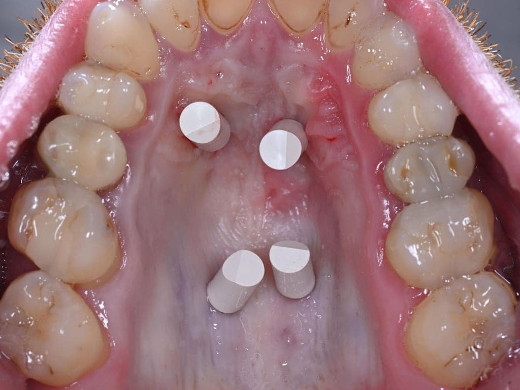 Scanbodies op de vier schroeven, vlak voor de intraorale scan waarop de expander wordt ontworpen.