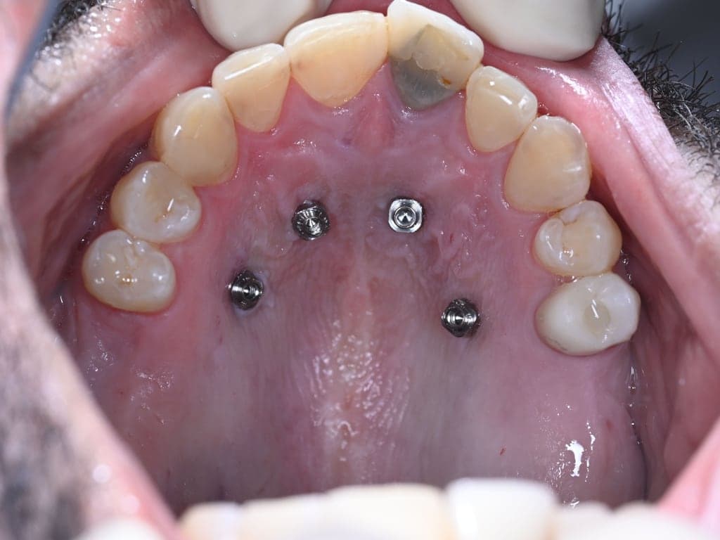 Vier mini-schroeven geplaatst; de expander volgt na de scan.