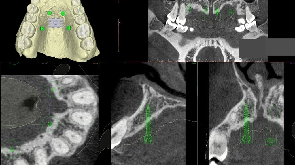 CBCT-planning: botdikte per schroefpositie, coronale doorsnede en dwarsdoorsnedes van 13 mm-schroeven.