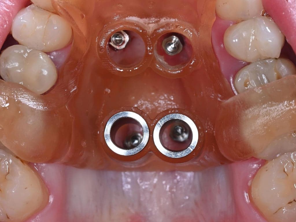 De 3D-geprinte geleider in de mond; de eerste twee schroeven zitten al door de voorste hulzen.