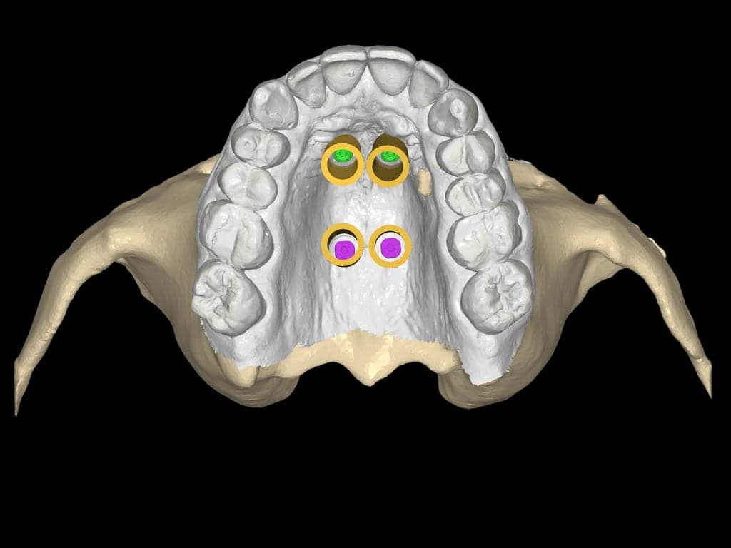 CBCT en intraorale scan samengevoegd: vier boorhulzen gepland op het gehemelte.